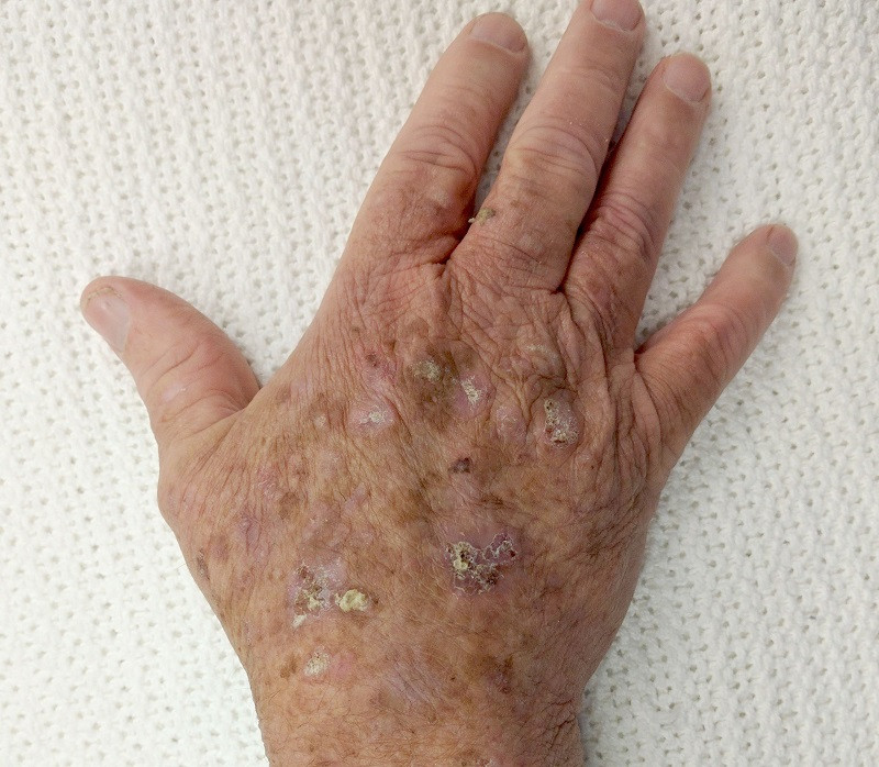 Queratosis actínica