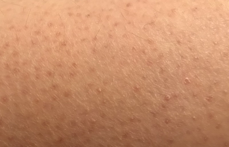 Queratosis pilar