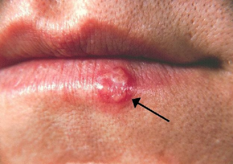 Herpes labial