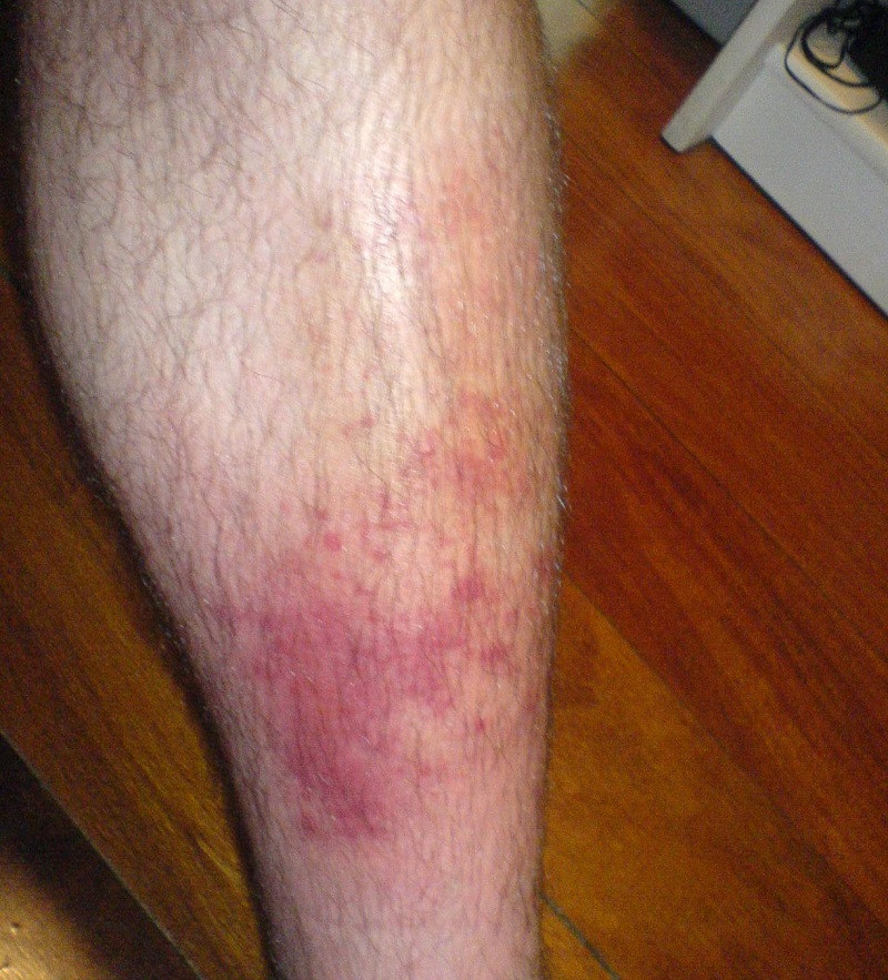 Celuitis por infección