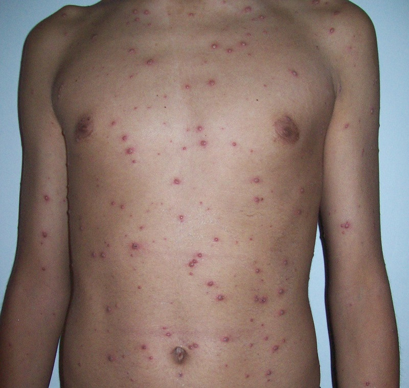 Varicela