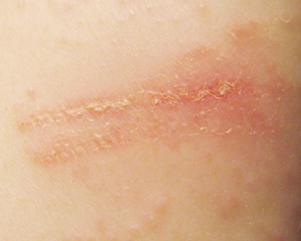 Dermatitis de contacto