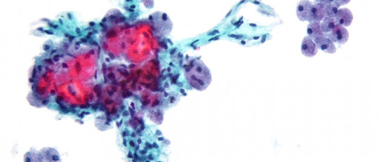 Imagen microscópica de una neoplasia.