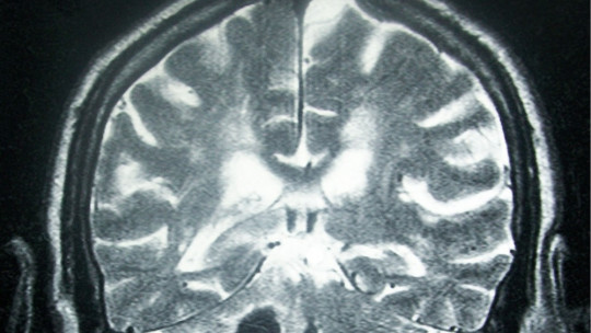Derrame cerebral.