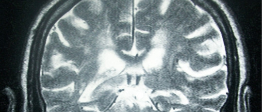 Derrame cerebral.