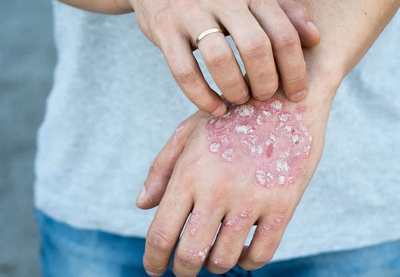 Psoriasis en la piel