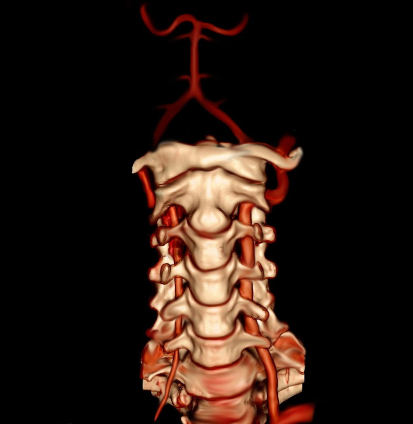 Arteria vertebral