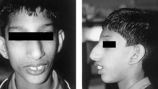 Niño con síndrome de Seckel.