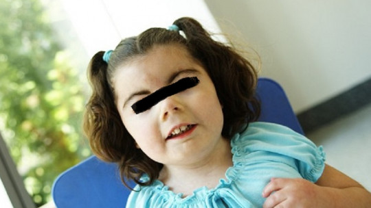 Niña con síndrome de Cornelia de Lange