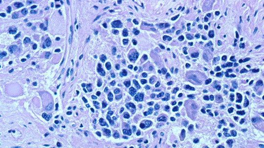 Neuroblastos.