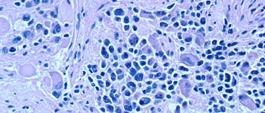 Neuroblastos.