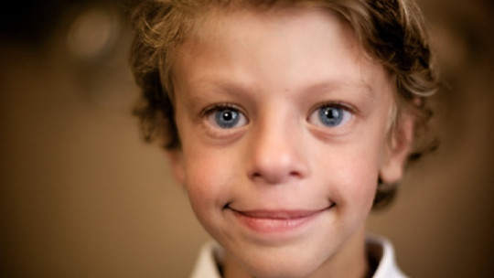 Niño con síndrome de Williams.