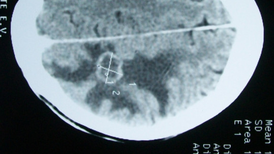 Edema cerebral.