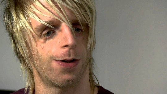 Sindrome de Treacher Collins.