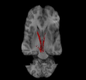 Vía nigroestriatal