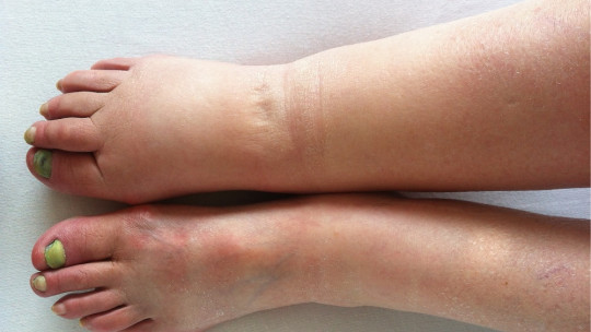 Elefantiasis