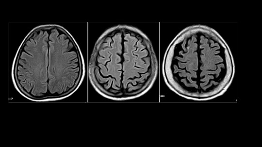 Atrofia cortical