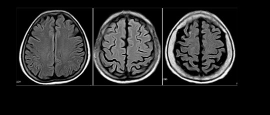 Atrofia cortical