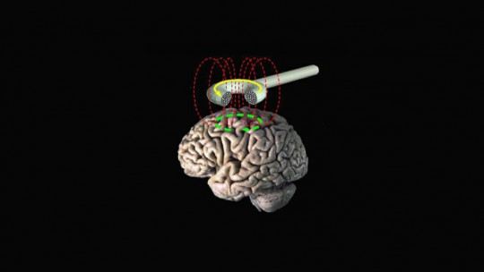 Estimulación magnética transcraneal