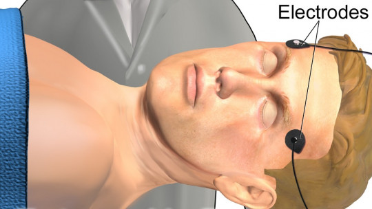 Terapia electroconvulsiva