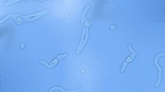 miodesopsias