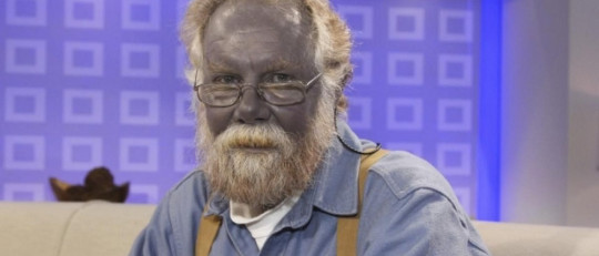 Metahemoglobinemia
