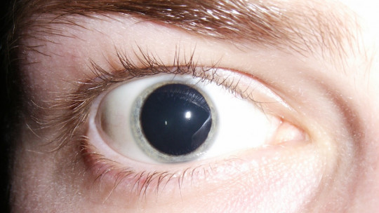 Midriasis