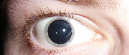 Midriasis