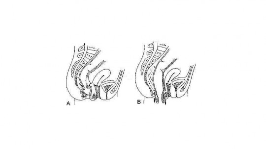 Prolapso rectal