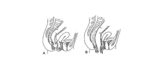 Prolapso rectal