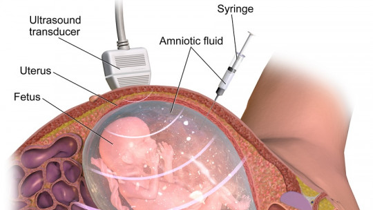 Amniocentesis
