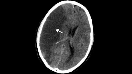 Isquemia cerebral