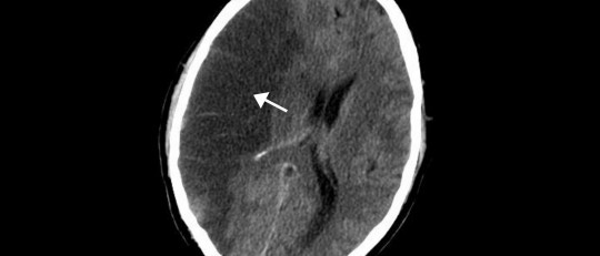 Isquemia cerebral