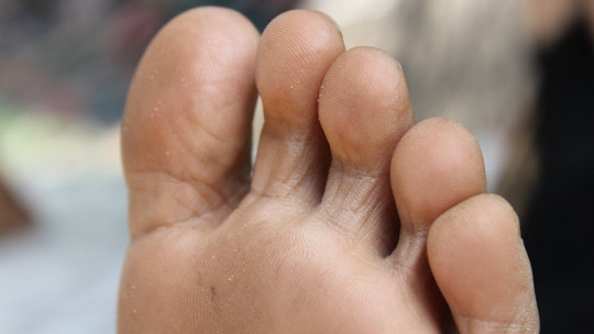 Hongos en los pies