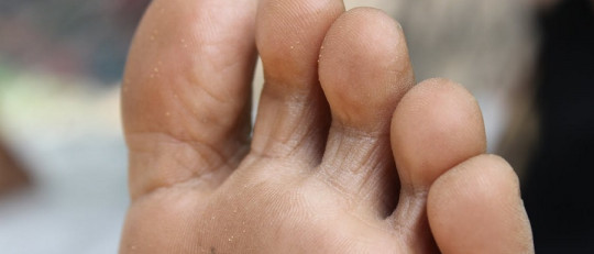 Hongos en los pies