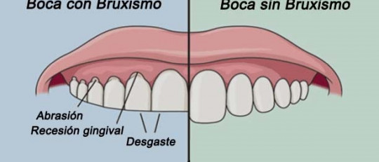 Bruxismo (rechinar los dientes): causas, síntomas y tratamiento