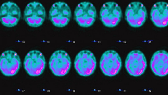 Spect cerebral