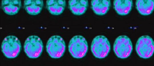 Spect cerebral