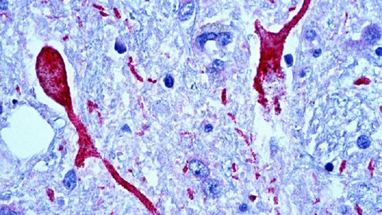 Encefalopatía TDP-43