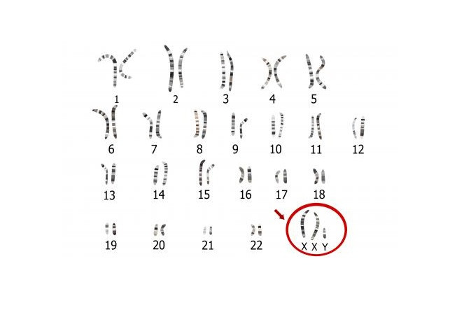 Diagnóstico del Síndrome de Klinefelter