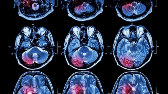 Diferencias entre la neuropsicología y la neurología