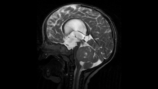Meduloblastoma