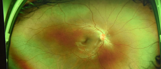 Partes de la retina