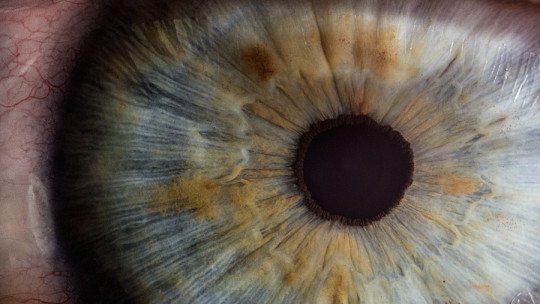 Apraxia oculomotora