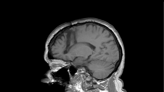 Los efectos de la lobotomía cerebral