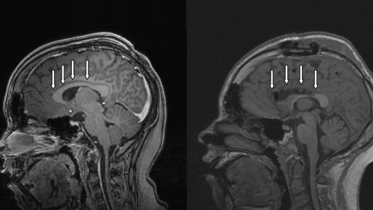 Síndrome de desconexión del cuerpo calloso