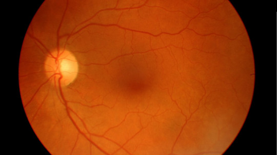 Degeneración macular