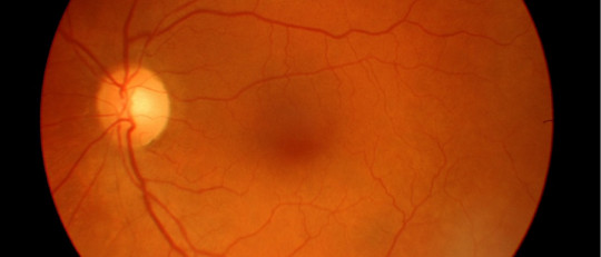 Degeneración macular