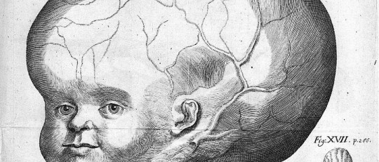 Hidrocefalia: causas, tipos y tratamientos
