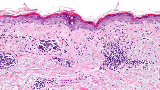 Lupus eritematoso sistémico